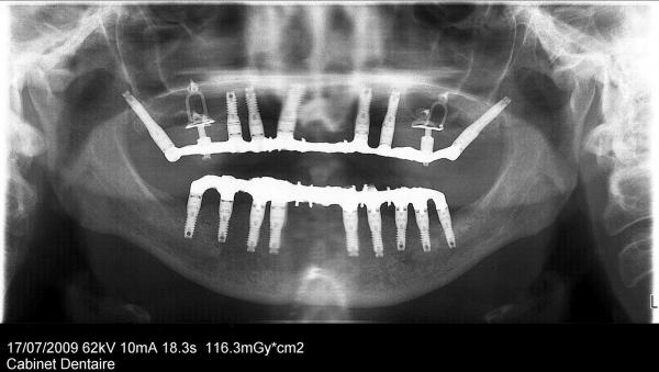 média: zoom_les-implants-dentaires_im92.jpg
